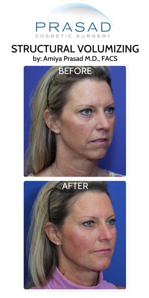 Before and after Y Lift Facelift performed by Dr Amiya Prasad