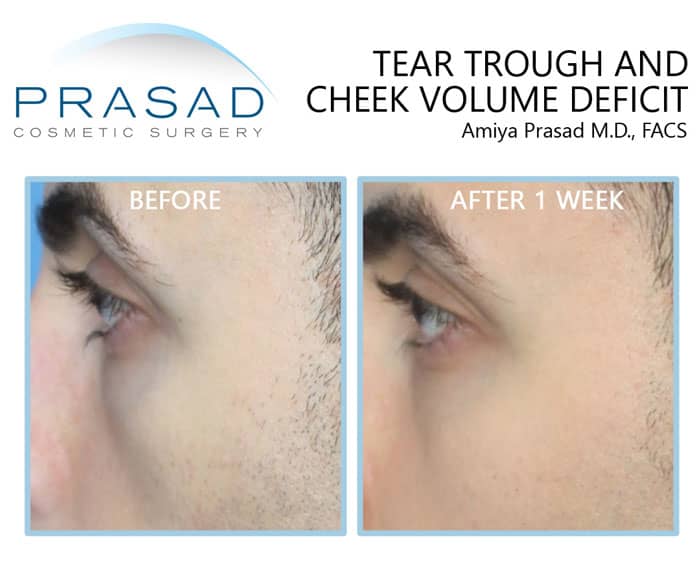 under eye filler before and after treatment results on young male patient in 30s