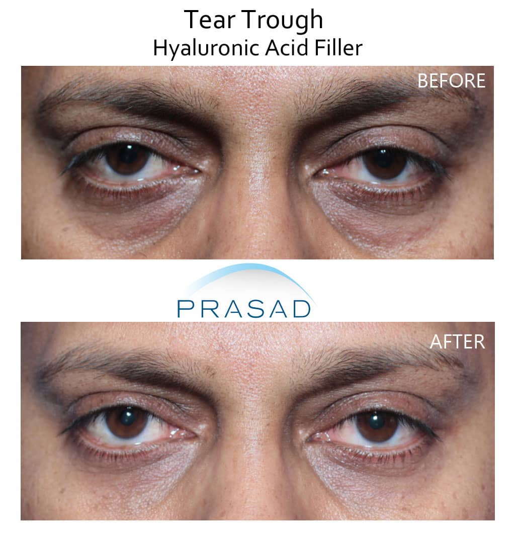 hollow under eye filler treatment before and after results on male patient in 40s