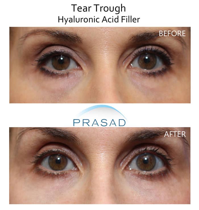 sunken eyes filler before and after treatment results on female patient in 40s