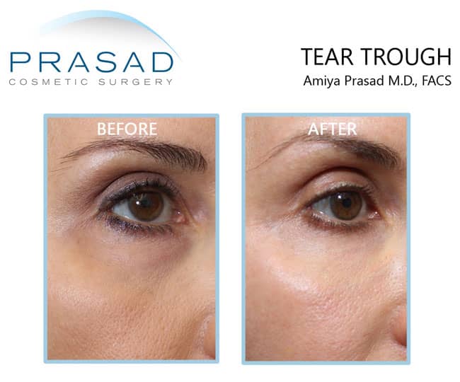 Undereye filler for eye bags before and after treatment results on female patient in 50s