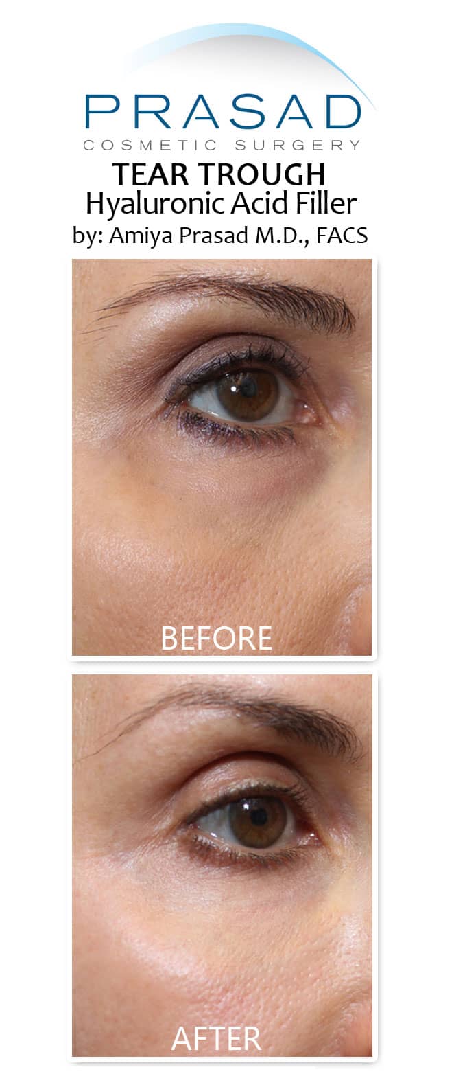 filler for under eye bags before and after treatment on female patient in 50s