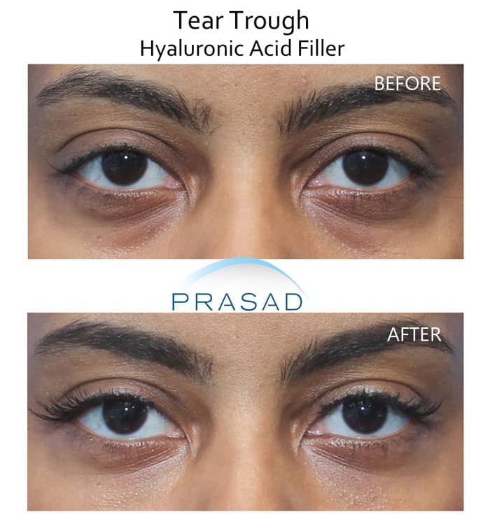 fillers for under eye bags before and after results on female patient in 30s