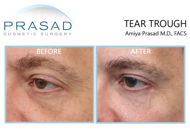 hollow eyes filler before and after treatment results on male patient in 50s