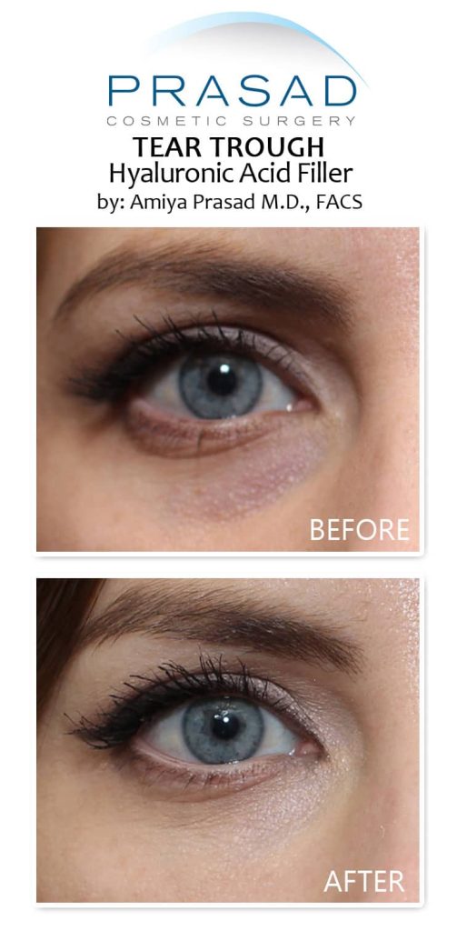 undereye filler treatment before and after results on young female patient