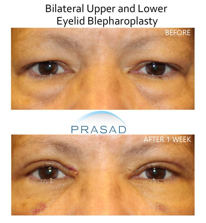 upper and lower eyelid surgery performed under local anesthesia before and after 1 week recovery