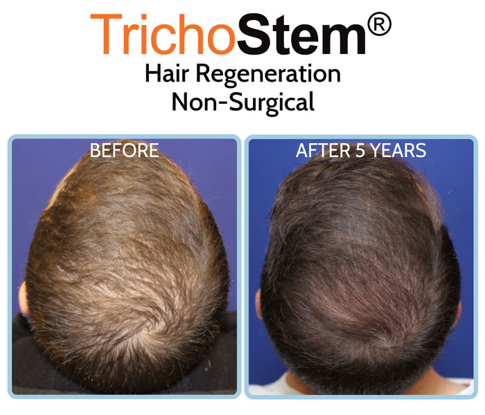 before and after 5 years of Trichostem Hair Regeneration treatment on male patient with hair thinning problem