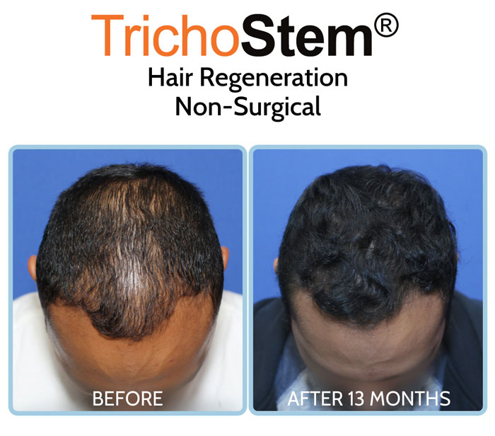 trichostem hair regeneration before and after results on male patient with hair loss - hair transplant alternative solution