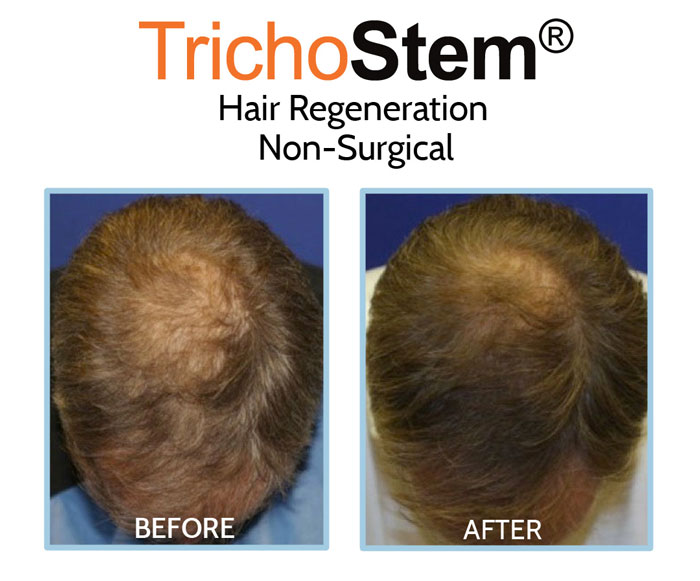 trichostem hair regeneration - hair transplant alternative before and after treatment results