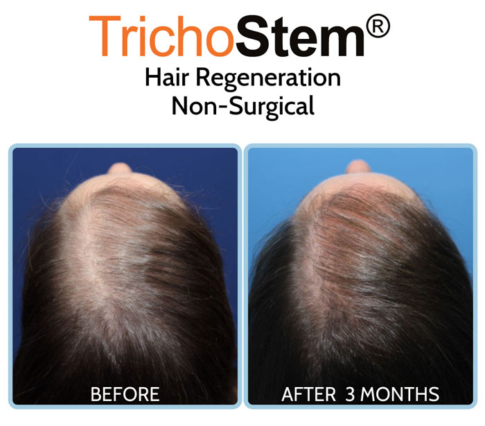 hair regeneration treatment results on patient who had hair transplant performed elsewhere