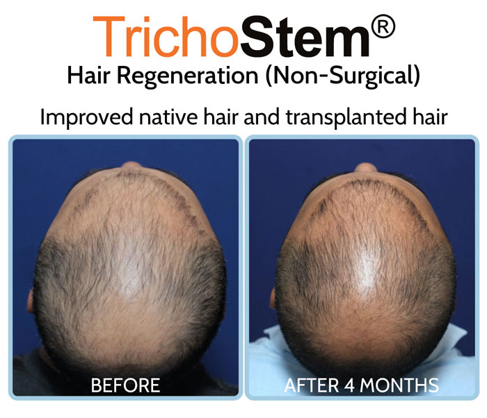 hair regeneration before and after treatment results - hair transplant alternative for male in 30s with advance hair loss