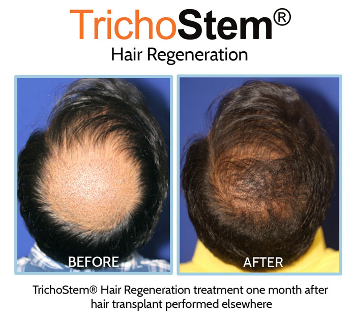 hair regeneration treatment results on patient who had hair transplant performed elsewhere