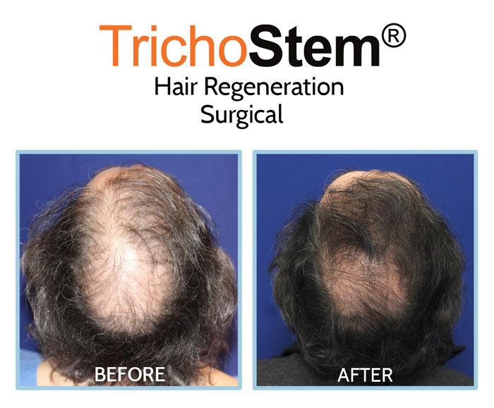 hair transplant and hair regeneration treatment results on male patient with advance hair loss on crown