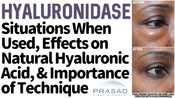 Hyaluronidase-situations-when-used-effects-on-natural-hyaluronic-acid-and-importance-of-techinique