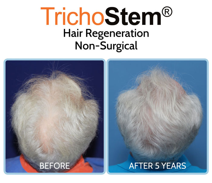 old male patient with hair thinning problem treated with Trichostem hair regeneration before and after treatment comparison