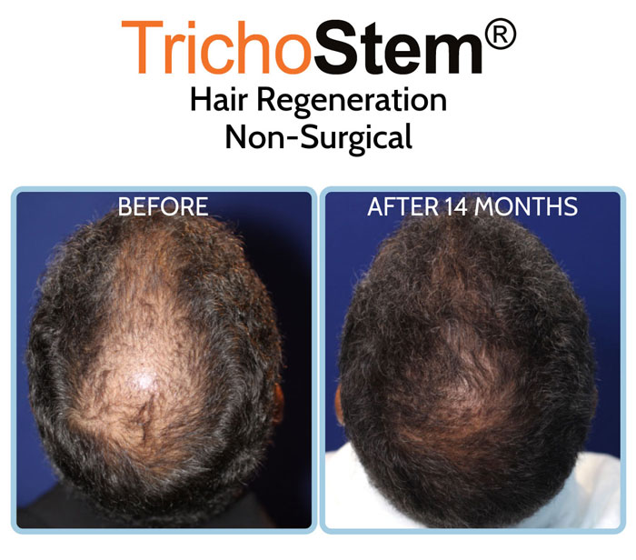 non-surgical hair transplant alternative results on male patient with hair thinning problem