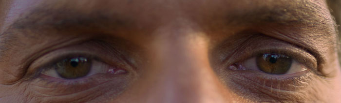 a person with upper eyelid hollowing