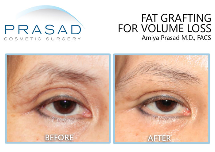 fat grafting before and after results. treatment for hollowing of the eyes without filler