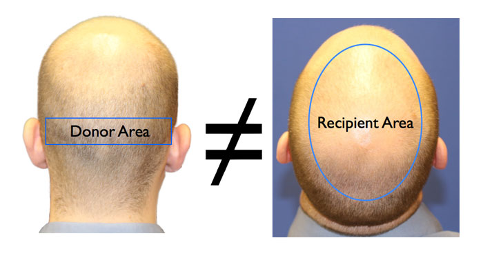 hair transplant donor area mismatching recipient area