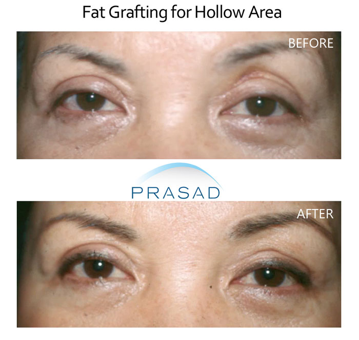 female patient in 60s with hollowing eyes treated with fat grafting before and after results