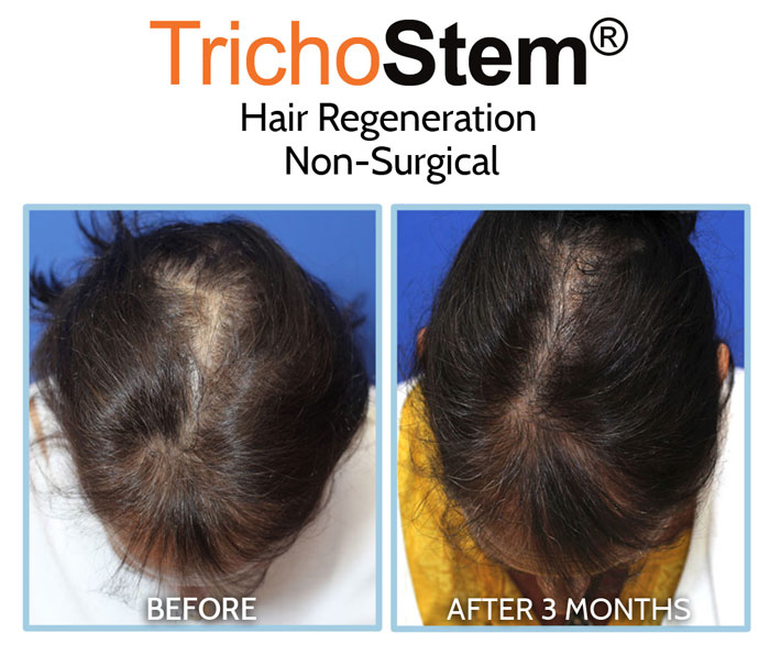 before and after Trichostem Hair Regeneration treatment on female pattern hair loss