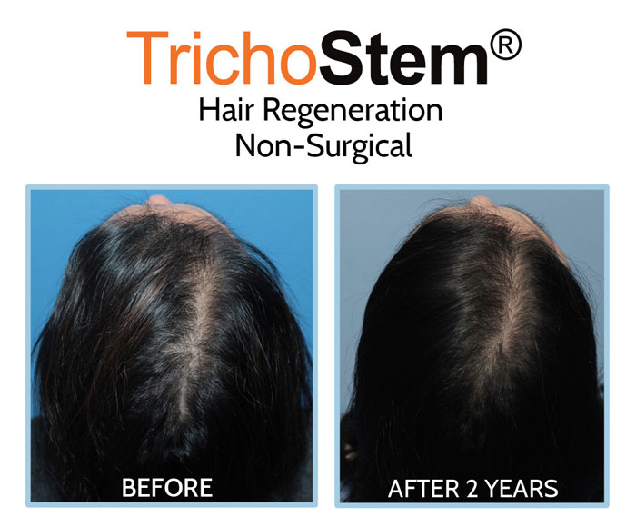 before and after Trichostem Hair Regeneration treatment on female patient who suffered from hair thinning