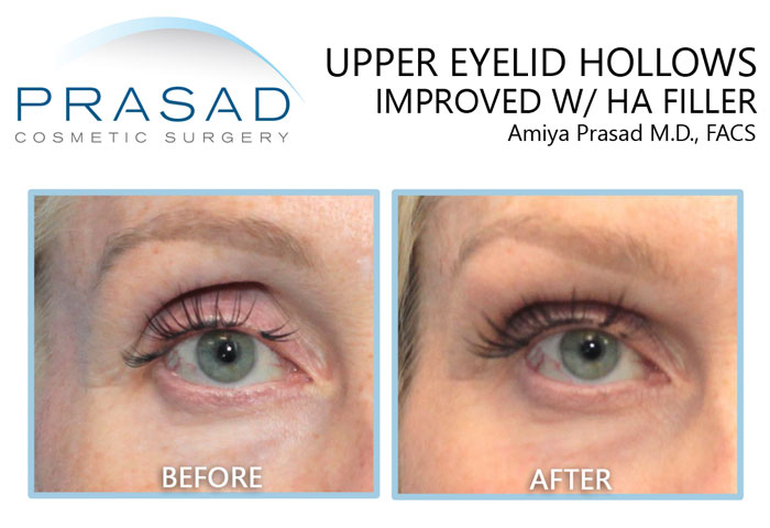 female patient in 50s with sunken eyes treated with filler before and after results