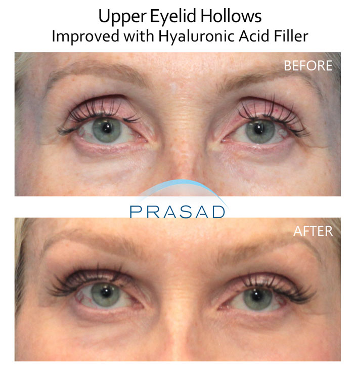 female patient with upper eyelid hollows treated with filler before and after results