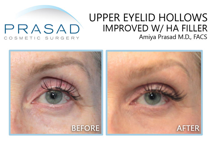 female patient with upper eyelid hollows treated with filler before and after results