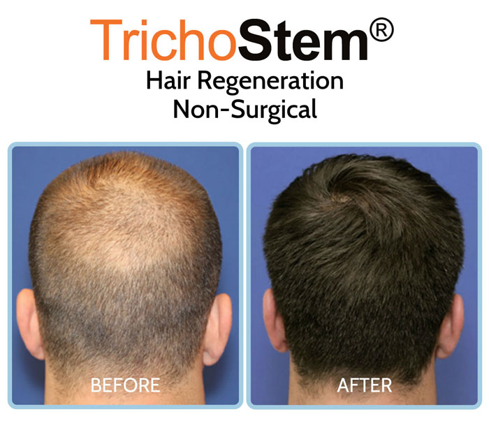 hair regeneration before and after results on male patient with advance hair loss problem