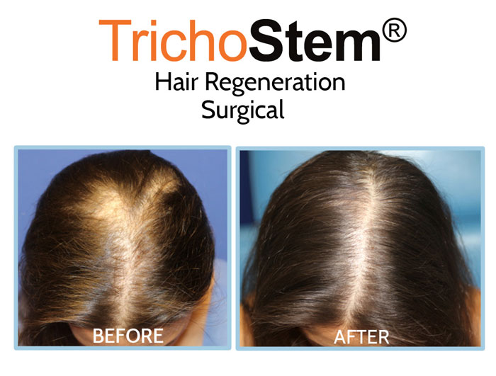 hair transplant plus hair regeneration before and after treatment results on female hair thinning