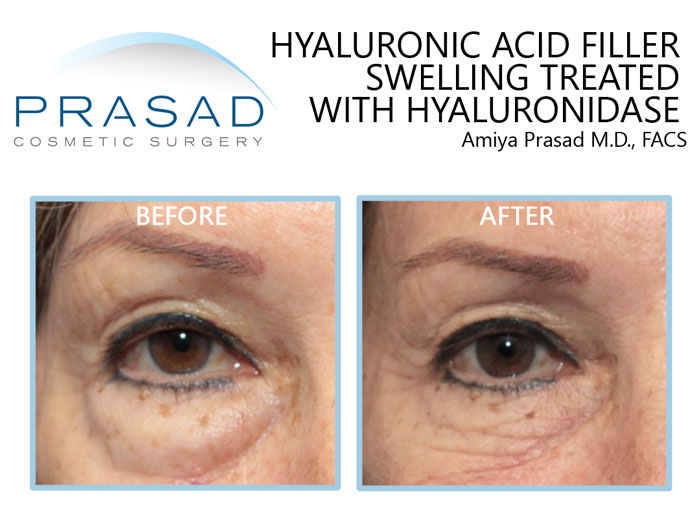 swelling after filler treated with hyaluronidase before and after