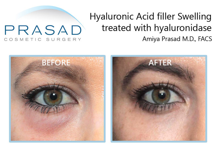 hyaluronidase injection to remove undesirable effects of filler