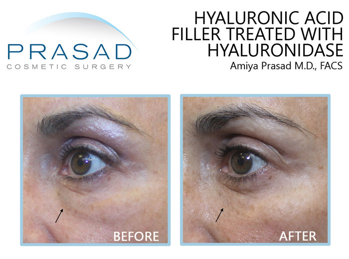 under eye filler treated with hyaluronidase before and after