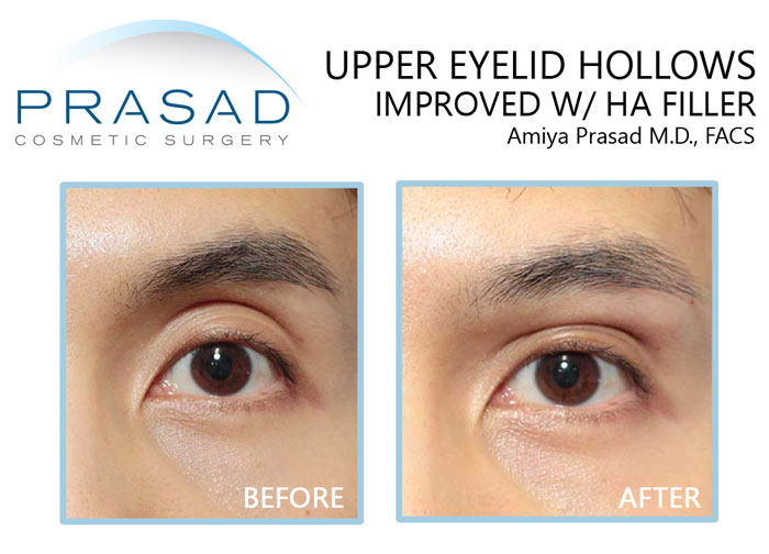 male patient with upper eyelid hollows treated with filler before and after results