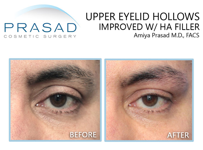 upper eyelid hollowing treatment with filler before and after comparison