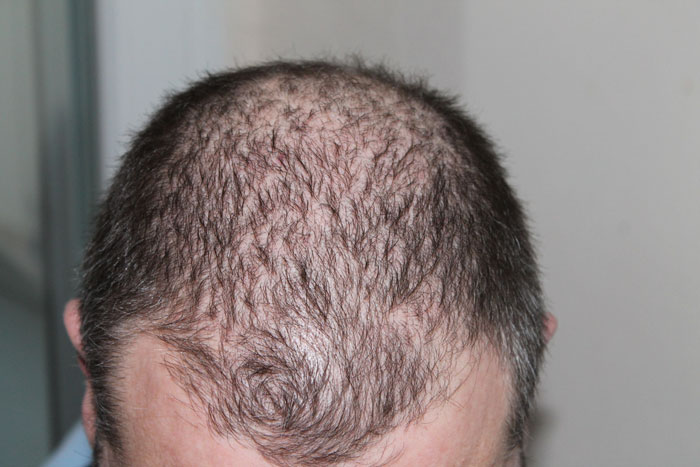 man suffering from hair thinning