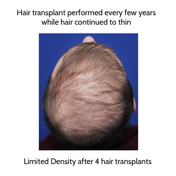 male patient with poor hair density after several hair transplant