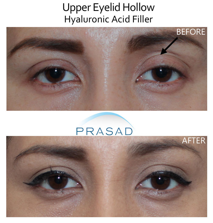 hollowing of the eyes on upper eyelid before and after treatment