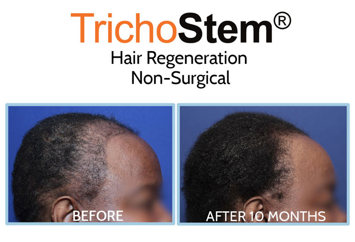 African-American hair loss treated with Hair Regeneration before and after results