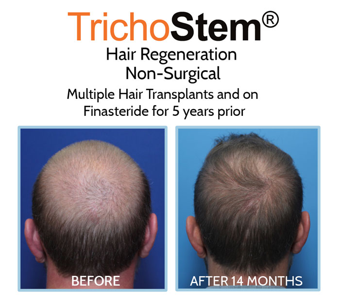 PRP + ACell for hair loss treatment in male who had several hair transplants, before and after more than a year results