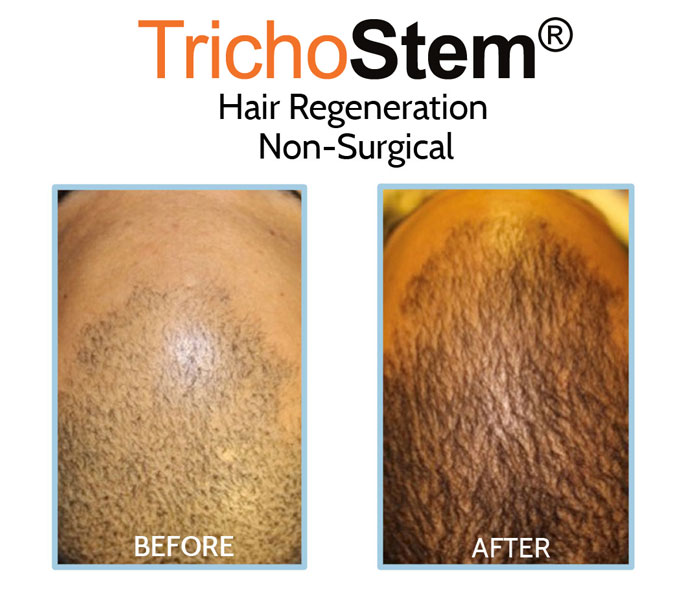 before and after results of Hair Regeneration treatment for male pattern baldness