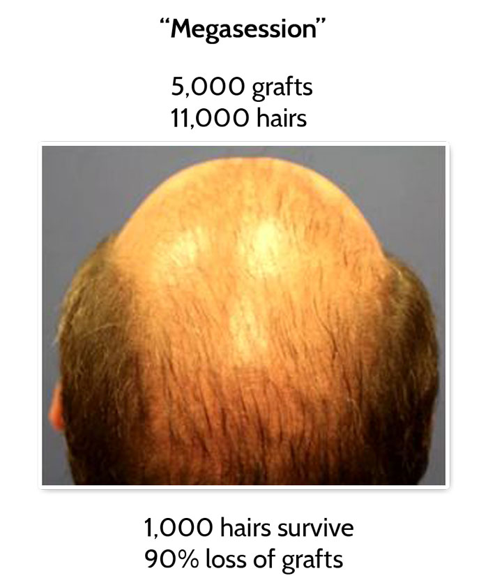 patient who have had megasession in hair transplantation