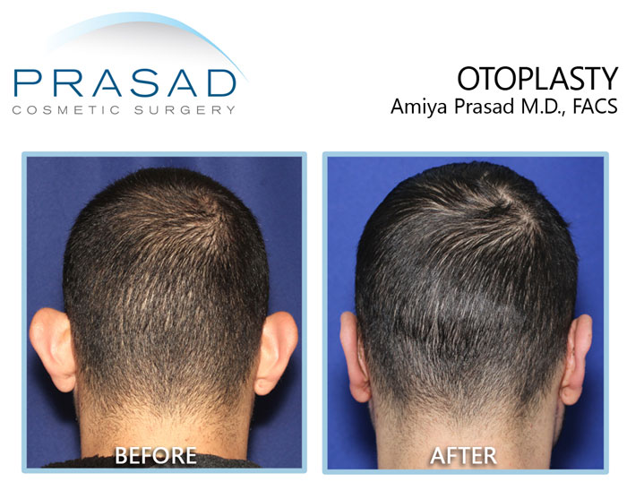 before and after otoplasty results of the young male patient