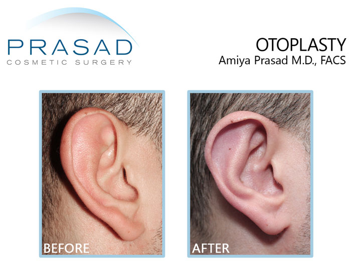 before and after ear pinning surgery results of the young male patient