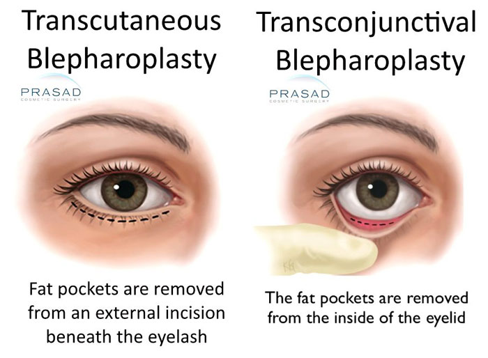 Transcutaneous vs Transconjunctival Blepharoplasty illustration