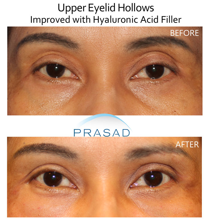 Removing too much fat during cosmetic eyelid surgery can result in a hollow appearance in the upper eyelids