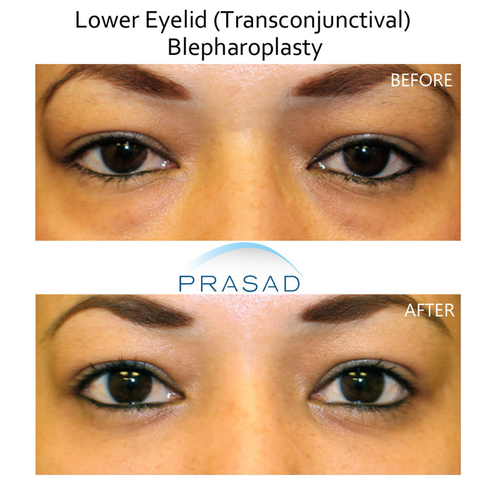 lower eyelid transconjunctival blepharoplasty before and after results on young female patient