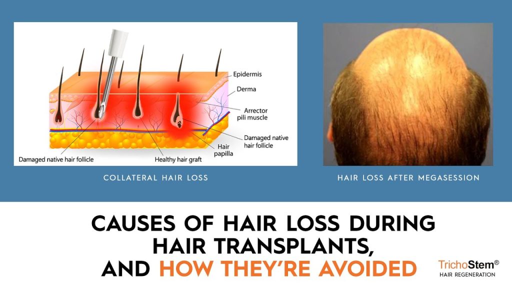 causes of hair loss during hair transplant