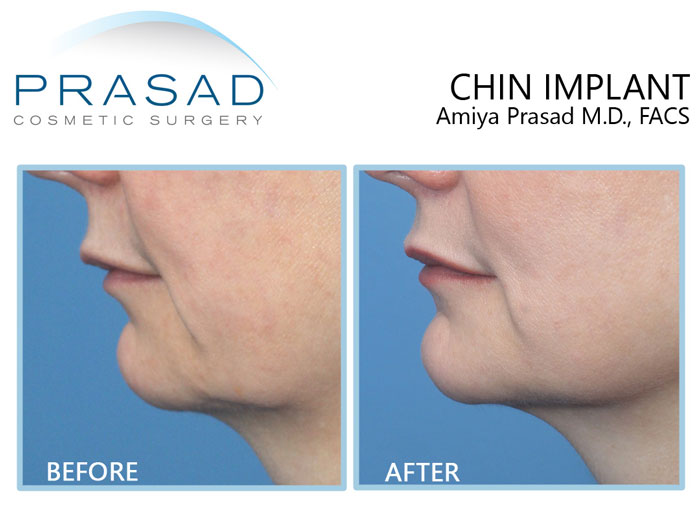 Chin implant for facial aging before and after treatment results on female patient in 40s